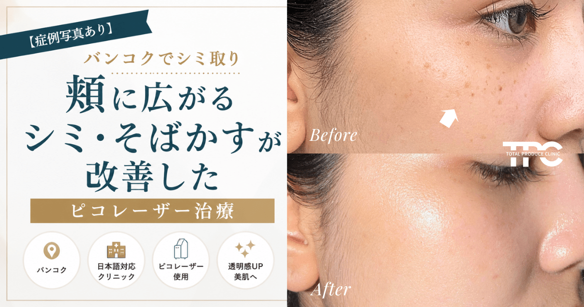 投稿についてもっと詳しく 【症例】バンコク シミ取り｜頬に広がるシミ・そばかす改善事例