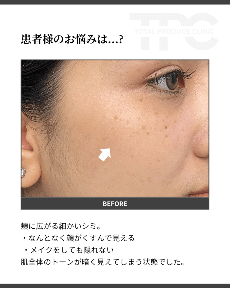 バンコクシミ取り